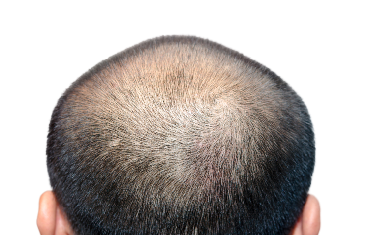 Hair Loss Men Treatment